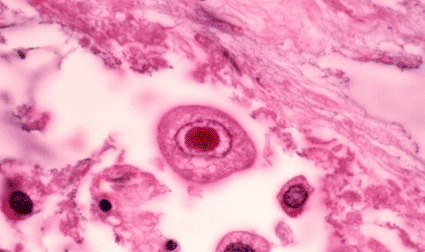 Image: Cytomegalovirus with a large inclusion in the nucleus of lung cells (photo courtesy Dr. Gladden Willis, Visuals Unlimited).